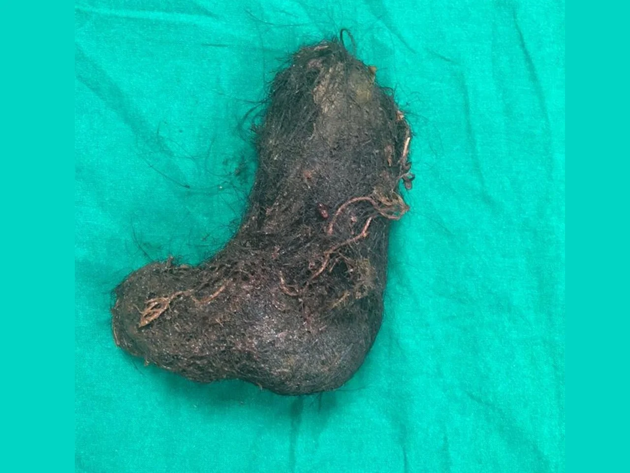 RAPUNZEL Syndrome Trichobezoar