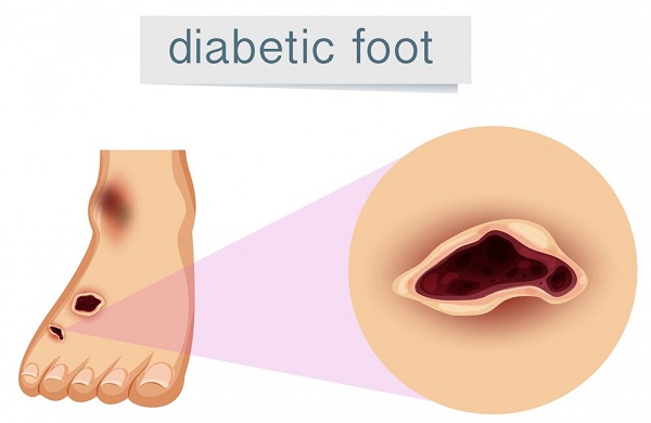 Diabetic Foot Ulcer Surgeries